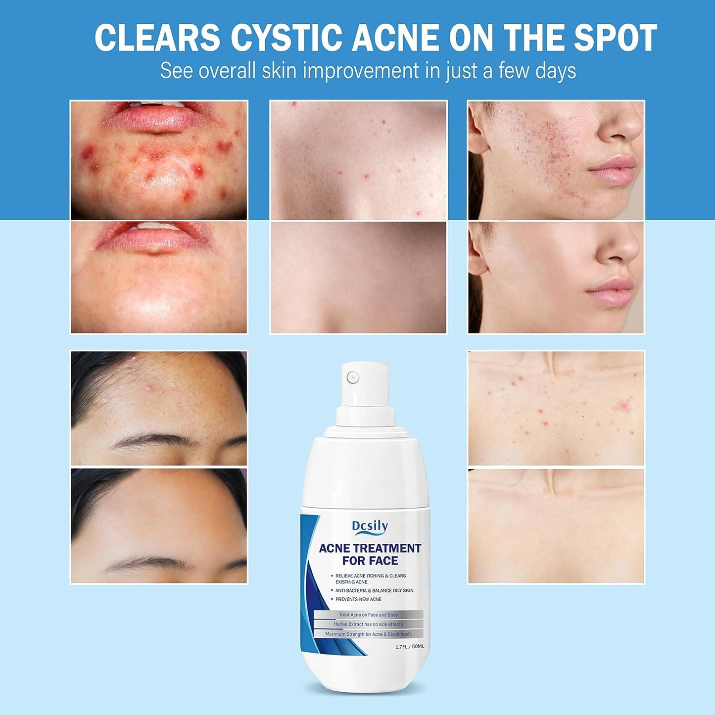 Severe Cystic Acne Treatment for Face, Body, Butt, Back - Hormonal Acne Scar Treatment Serum, Herbaluxy Formula with Salicylic Acid, Acne Spot Treatment Cream